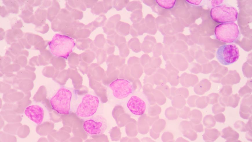 Linfoma